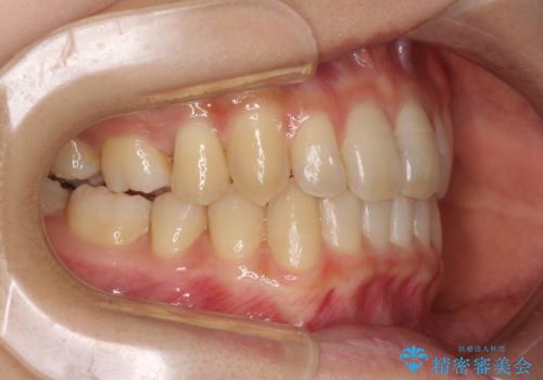 奥歯の反対咬合 上顎骨を拡大してインビザラインで矯正の治療後