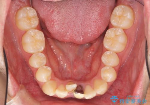インビザライン矯正　神経のない歯をとって、全て天然歯に　の治療前