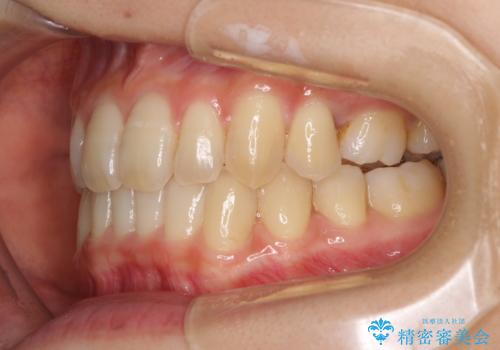 奥歯の反対咬合 上顎骨を拡大してインビザラインで矯正の治療後