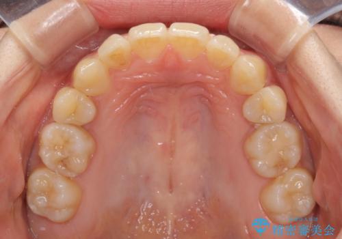 奥歯の反対咬合 上顎骨を拡大してインビザラインで矯正の治療後