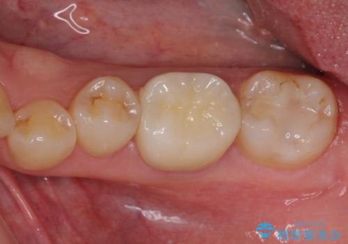 大きな虫歯で歯が欠けた　神経を極力残した治療の症例 治療後