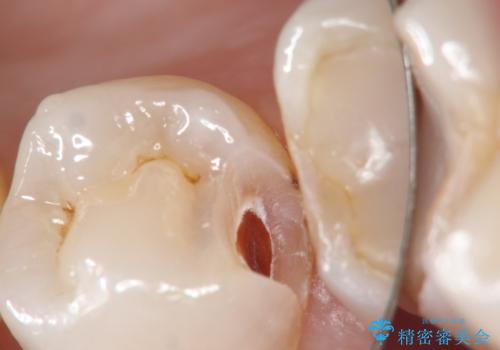 プレスセラミックインレー。精度にこだわるの治療中