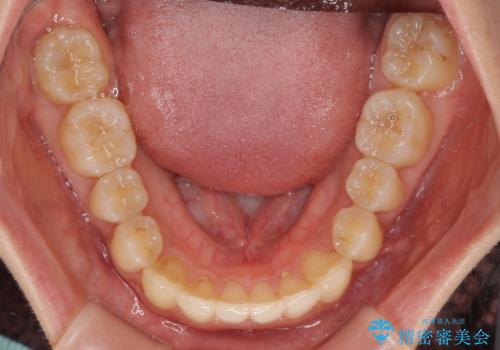 奥歯の反対咬合 上顎骨を拡大してインビザラインで矯正の治療後