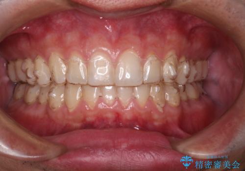 下の前歯のがたがたを治したい。インビザラインライトの治療中