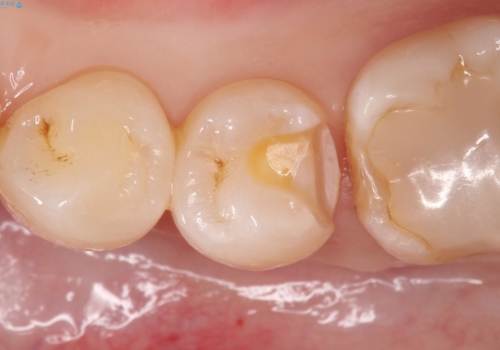 プレスセラミックインレー。精度にこだわる