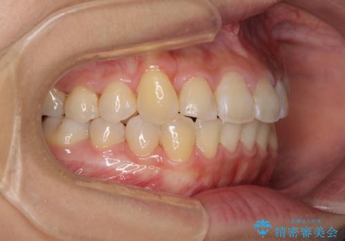埋もれた八重歯を引っ張り出す　目立たない矯正装置の治療後
