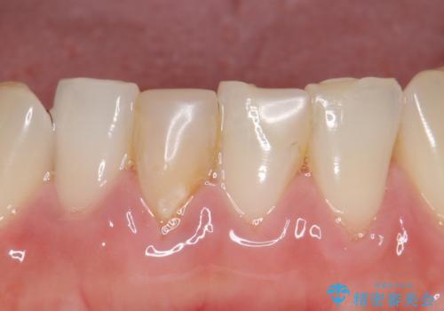 オールセラミッククラウン(スペシャル) 見た目が気になる前歯を綺麗にの治療前