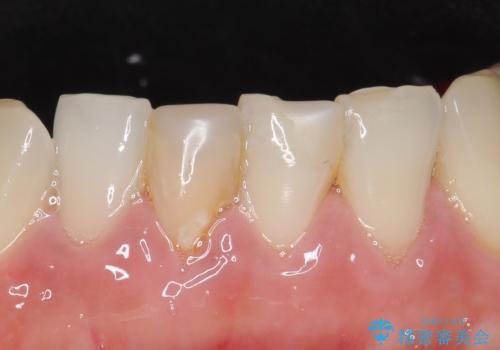 オールセラミッククラウン(スペシャル) 見た目が気になる前歯を綺麗にの治療前