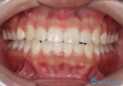 前歯のガタガタを目立たずきれいにしたい　インビザラインによる見えない矯正の治療後