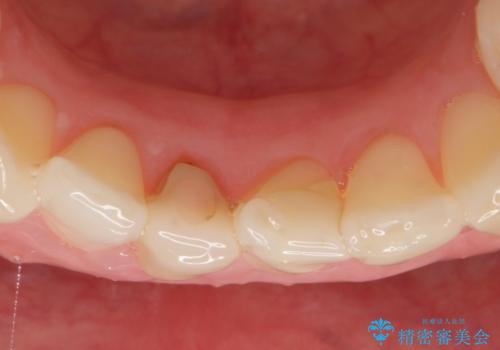 オールセラミッククラウン(スペシャル) 見た目が気になる前歯を綺麗にの治療前