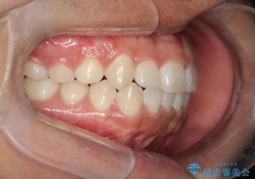 前歯のガタガタを目立たずきれいにしたい　インビザラインによる見えない矯正の治療後