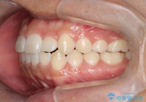 前歯のガタガタを目立たずきれいにしたい インビザラインによる見えない矯正の治療後