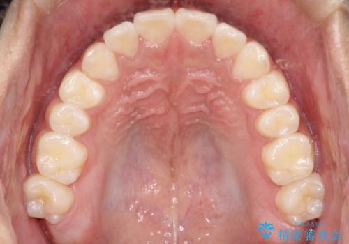 前歯のガタガタを目立たずきれいにしたい インビザラインによる見えない矯正の治療後