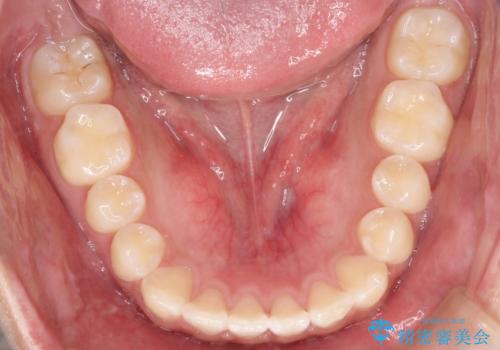 前歯のガタガタを目立たずきれいにしたい インビザラインによる見えない矯正の治療後