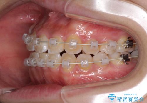 埋もれた八重歯を引っ張り出す　目立たない矯正装置の治療中