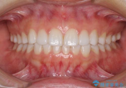 インビザラインによる軽度な出っ歯の矯正治療