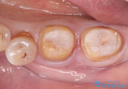 奥歯の被せ物をしたい。しみる奥歯、アイスを食べたい。の治療中