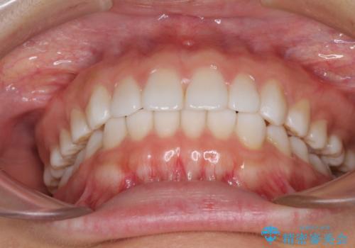 インビザラインによる軽度な出っ歯の矯正治療の治療後