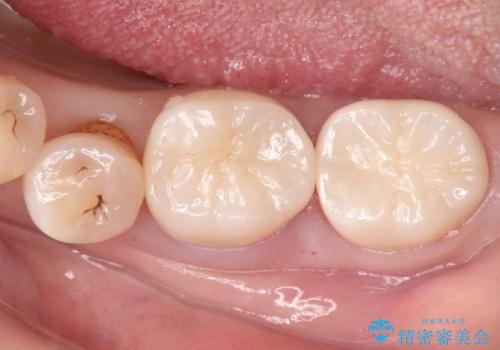 奥歯の被せ物をしたい。しみる奥歯、アイスを食べたい。の治療後