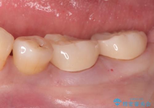 奥歯の被せ物をしたい。しみる奥歯、アイスを食べたい。の治療後