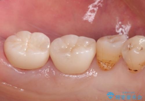 奥歯の被せ物をしたい。しみる奥歯、アイスを食べたい。の治療後