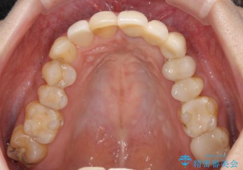 歯肉移植を用いた前歯のオールセラミックブリッジの治療後