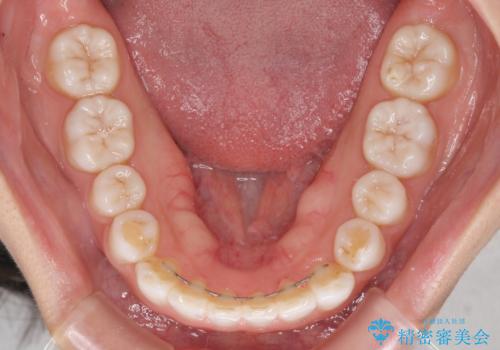 インビザラインによる軽度な出っ歯の矯正治療の治療後