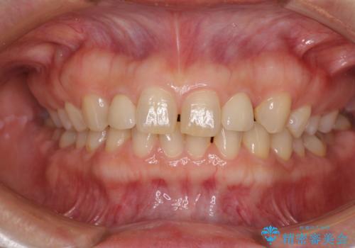 矮小歯のセラミック治療　小さい前歯を自然に仕上げるの治療後