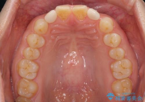 矮小歯のセラミック治療　小さい前歯を自然に仕上げるの治療後