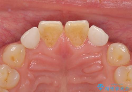 矮小歯のセラミック治療　小さい前歯を自然に仕上げるの治療後