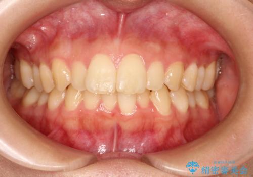 出ている前歯をインビザラインにて引っ込めるの治療前