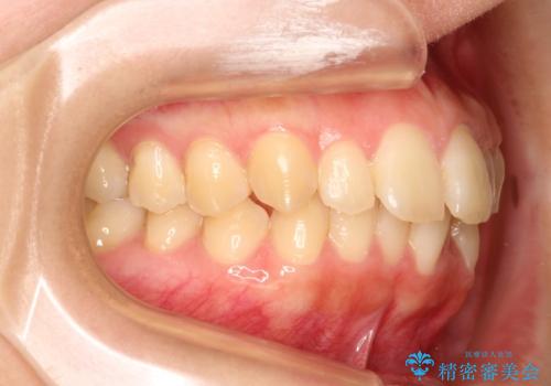 出ている前歯をインビザラインにて引っ込めるの治療前