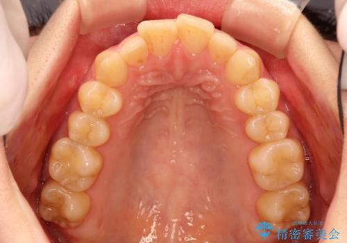 出ている前歯をインビザラインにて引っ込めるの治療前
