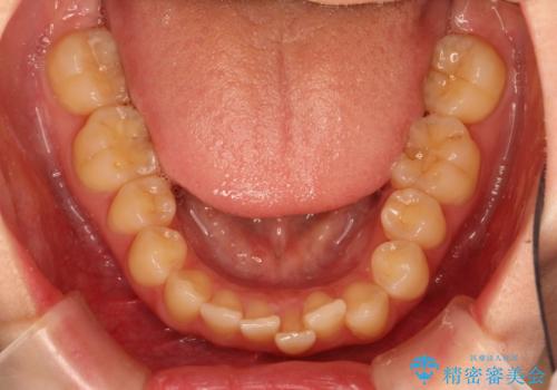 出ている前歯をインビザラインにて引っ込めるの治療前