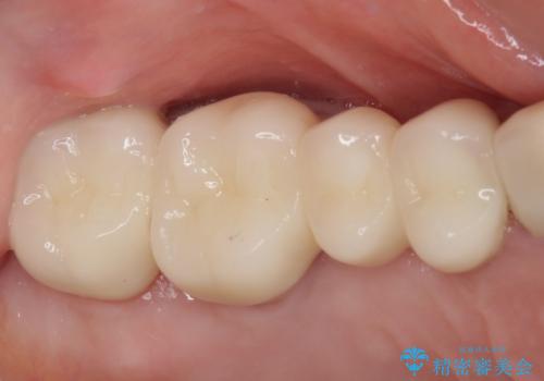 奥歯の歯槽骨が失われた 歯周外科処置後のセラミックブリッジの治療後
