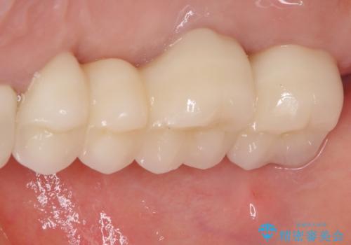 奥歯の歯槽骨が失われた 歯周外科処置後のセラミックブリッジの治療後