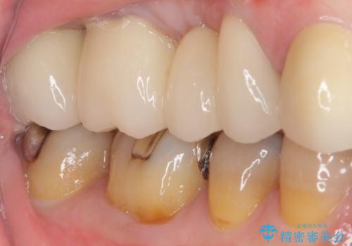 奥歯の歯槽骨が失われた 歯周外科処置後のセラミックブリッジの治療後