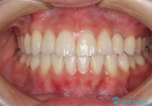 インビザライン矯正とインプラント治療と 総合歯科治療