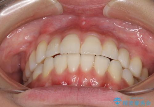 インビザライン矯正とインプラント治療と 総合歯科治療の治療後