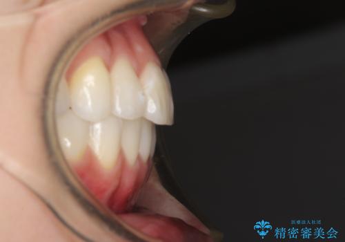 インビザライン矯正とインプラント治療と 総合歯科治療の治療後