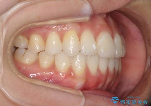 インビザライン矯正とインプラント治療と 総合歯科治療の治療後