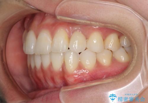 インビザライン矯正とインプラント治療と 総合歯科治療の治療後
