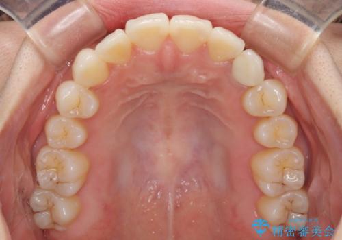 インビザライン矯正とインプラント治療と 総合歯科治療の治療後