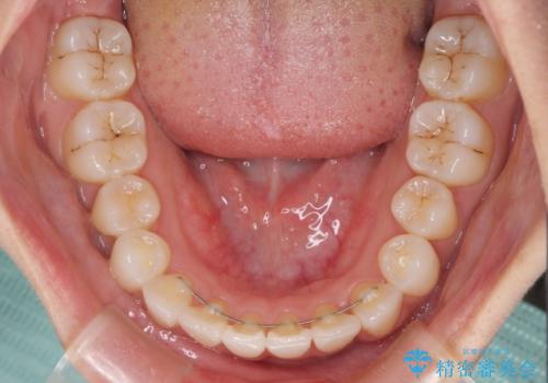 インビザライン矯正とインプラント治療と 総合歯科治療の治療後