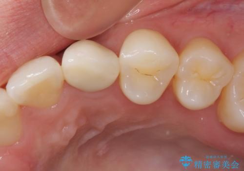 インビザライン矯正とインプラント治療と 総合歯科治療の治療後
