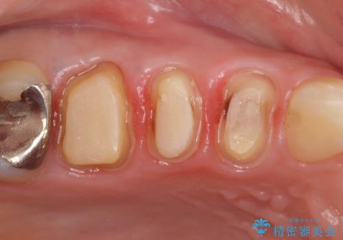 オールセラミッククラウン 咬合痛のある歯の治療の治療中