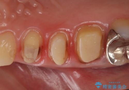 オールセラミッククラウン 咬合痛のある歯の治療の治療中