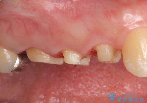 オールセラミッククラウン 咬合痛のある歯の治療の治療中