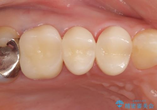 オールセラミッククラウン 咬合痛のある歯の治療の治療後