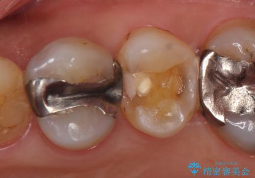 セラミックインレー　脱離した銀歯の治療の症例 治療前
